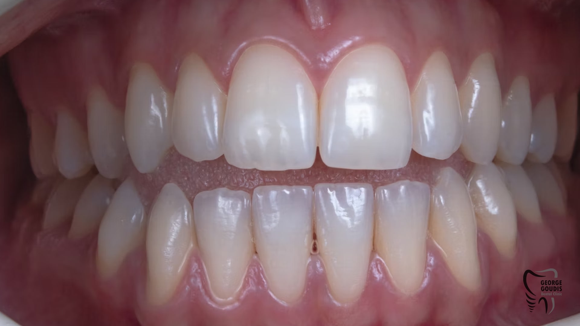 Γιατί έχω κίτρινα δόντια Γιατί έχω κίτρινα δόντια